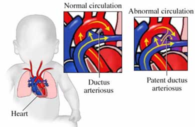 Image result for Patent Ductus Arteriosus