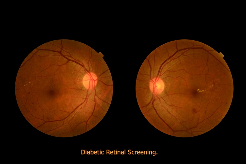 Diabetic Eye Screening