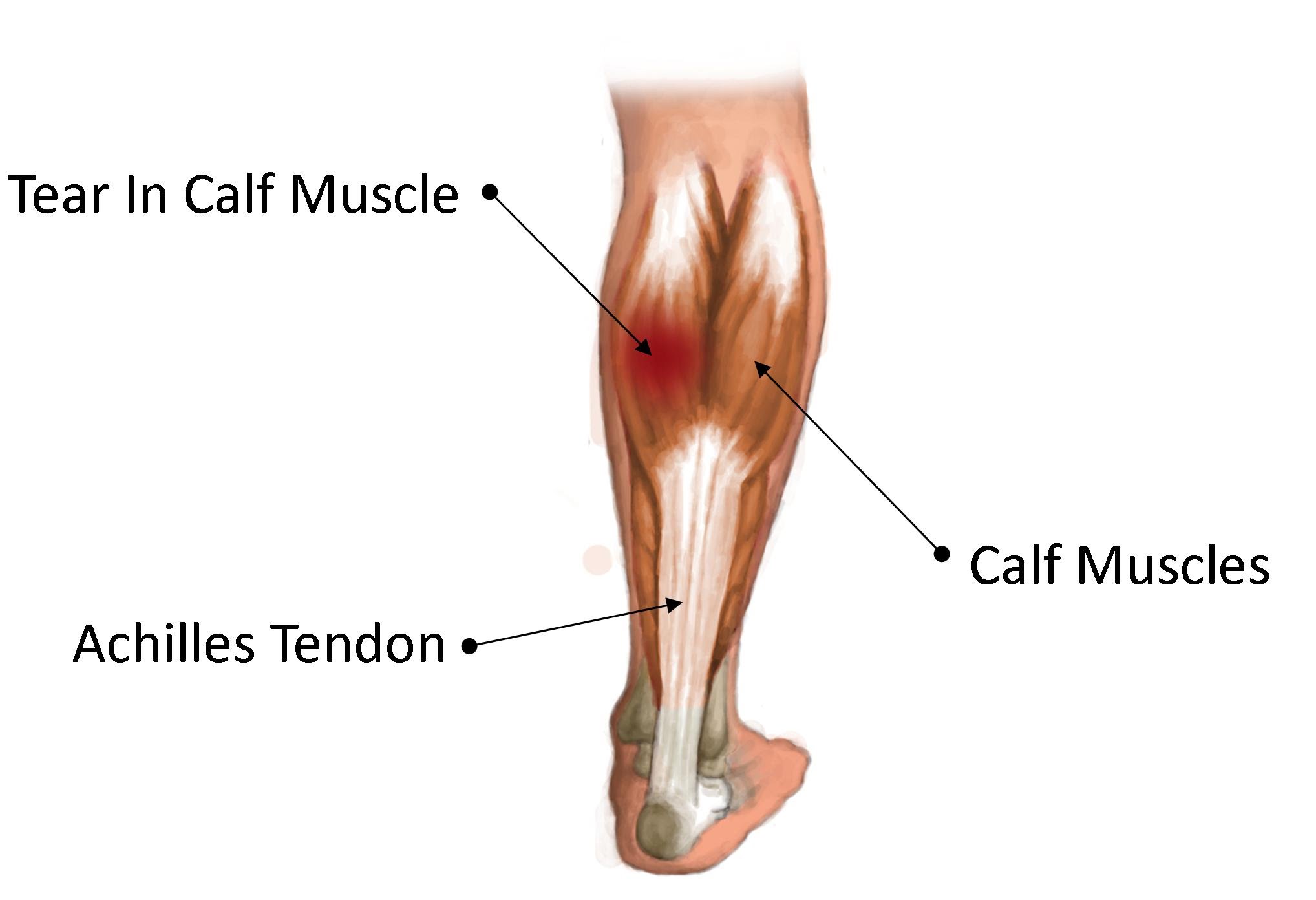 Image result for muscle tear