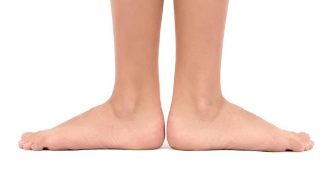 Image result for flat foot home remedies