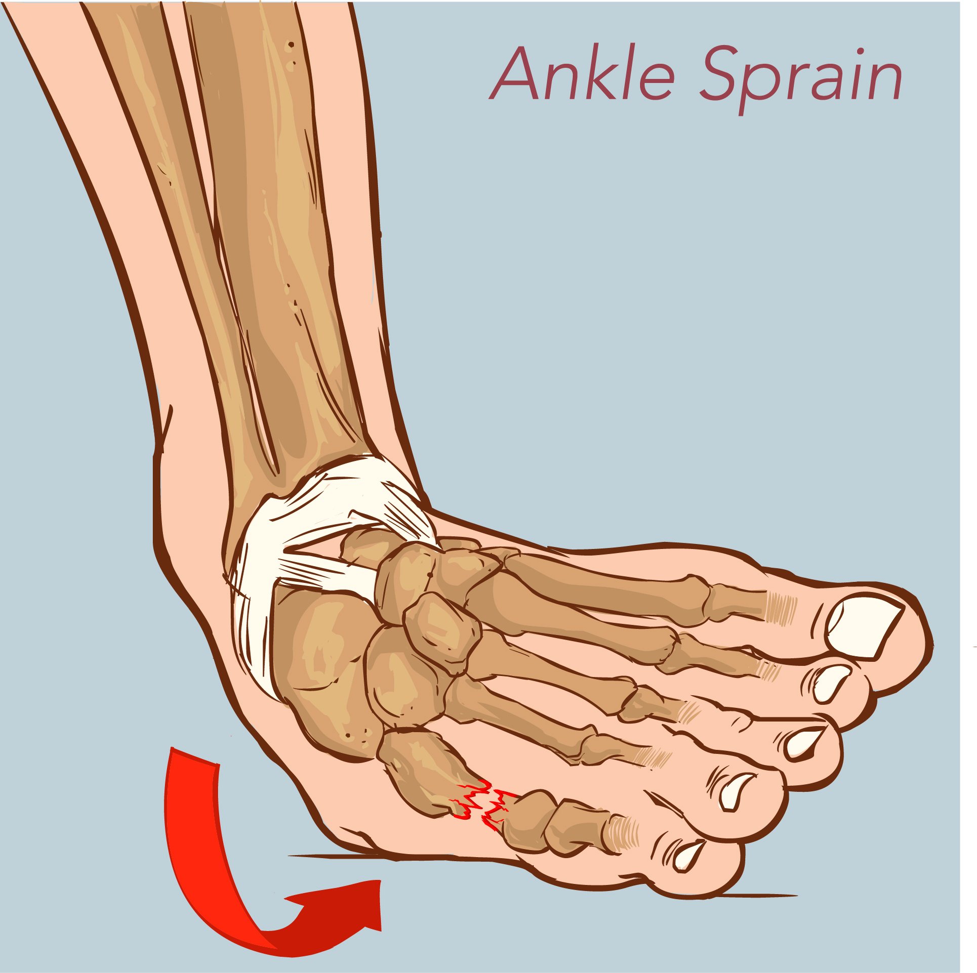 Image result for SPRAIN