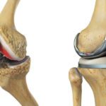 knee replacement surgeon in india
