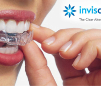 most common question on invisalign