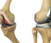 knee replacement surgeon in india