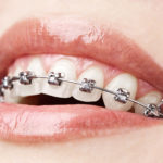 Top 4 Tips on How to Care For Braces