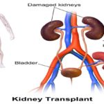 Kidney transplant cost in india