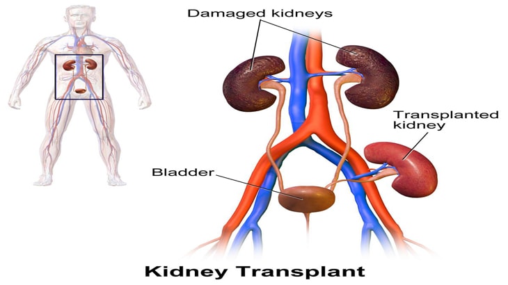 Kidney transplant cost in india