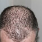 How to prevent hair loss?