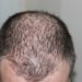 How to prevent hair loss?